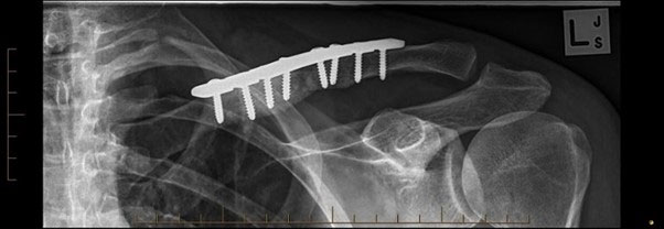 Arthroscopic assessment of the shoulder