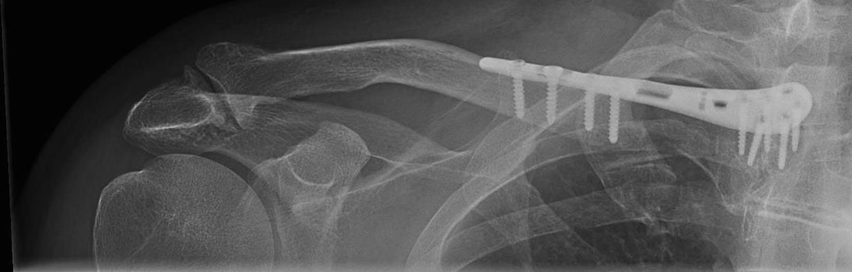  medial collar bone fracture one week after surgery – it shows the anatomical alignment and fixation of the collar bone using a long clavicle plate.