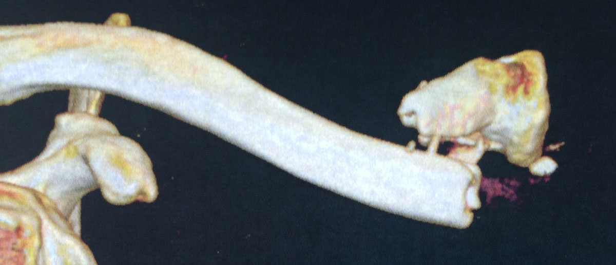 3D CT image of a displaced, comminuted medial collar bone fracture