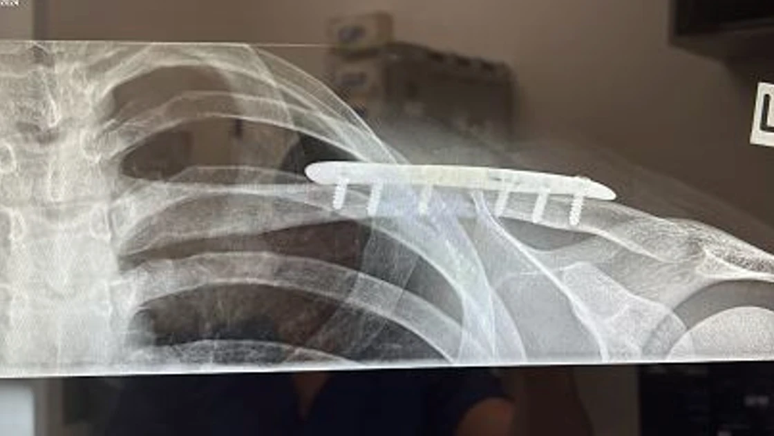 Post-op imaging - Xray showing anatomical fixation of the clavicle.