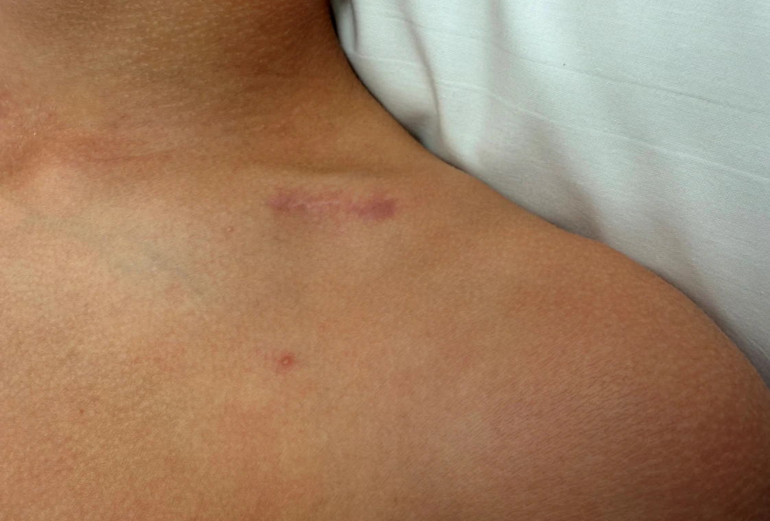 Post op imaging - Small scar