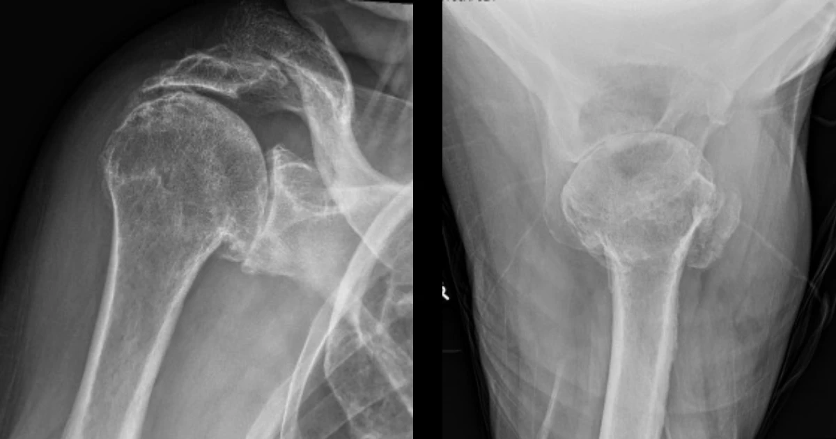 Peter is a 77-year-old man who first presented eleven years ago following a fall and injury to his right shoulder. 