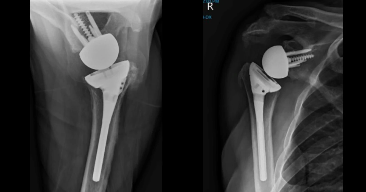 This shows a displaced and shortened 2 part fracture of the midshaft of the clavicle.
