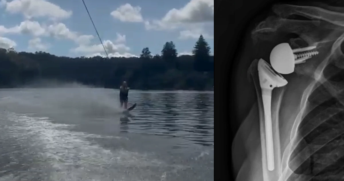 Waterskiing after a reverse shoulder replacement in a 77 year old.