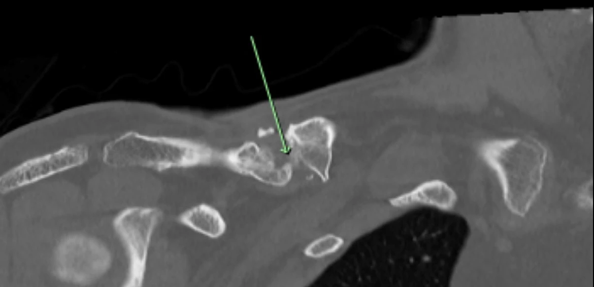 Pre op CT 1 showing site of non union