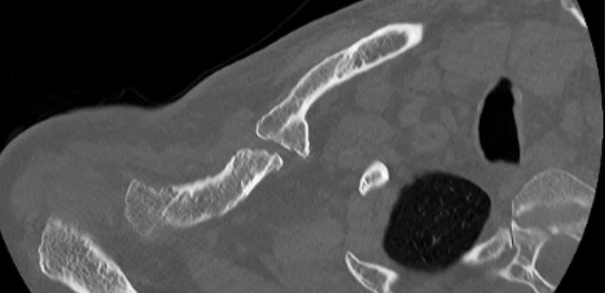 Pre op CT 2 showing site of non union