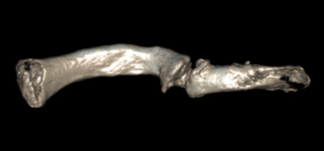 Pre op 3D model 1 clavicle nonunion