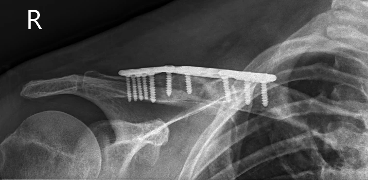 Post op xray 1 of clavicle  open reduction and internal fixation of the right clavicle with iliac crest bone grafting 