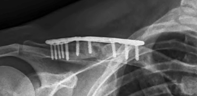 Post op xray 2 of clavicle  open reduction and internal fixation of the right clavicle with iliac crest bone grafting 