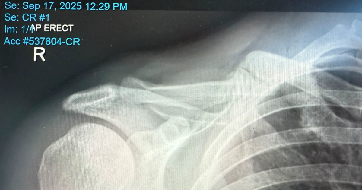 Waterskiing after a reverse shoulder replacement in a 77 year old.
