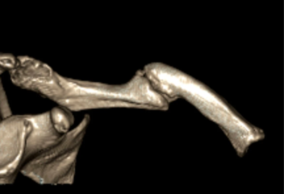 Pre op CT 1 showing site of non union