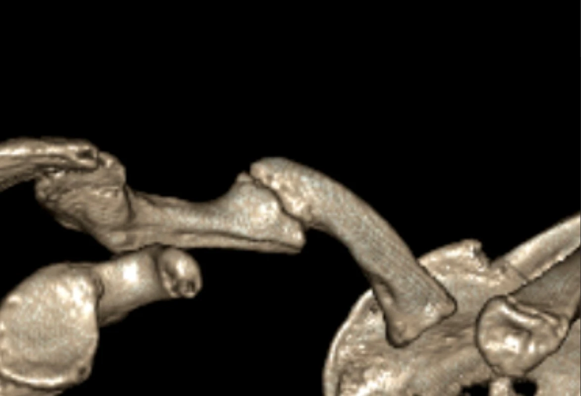 Pre op CT 2 showing site of non union