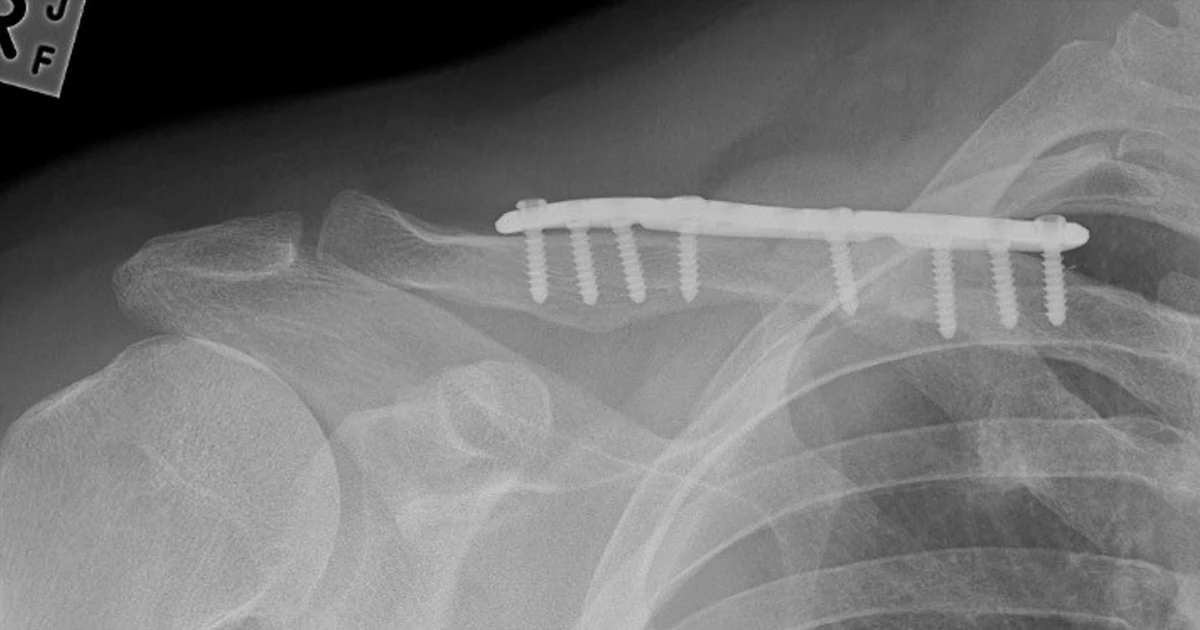 Post op xray 1 of clavicle  open reduction and internal fixation of the right clavicle with iliac crest bone grafting 